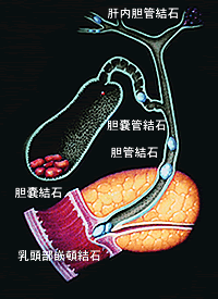総胆管結石　胆管結石　胆嚢結石　
LCBDE　胆管切開切石術　C-tube
胆嚢摘出　腹腔鏡