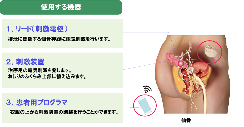 仙骨神経刺激療法