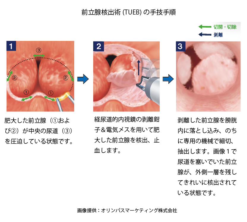 TUBEの手術手順
