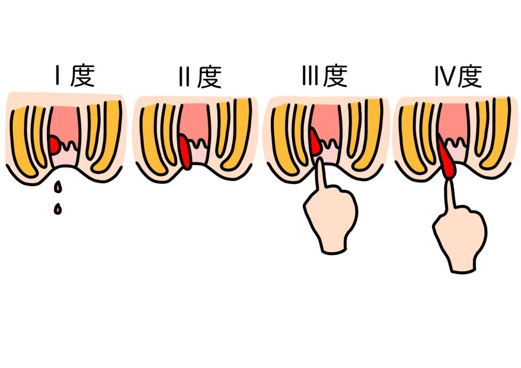 内痔核の状態と症状