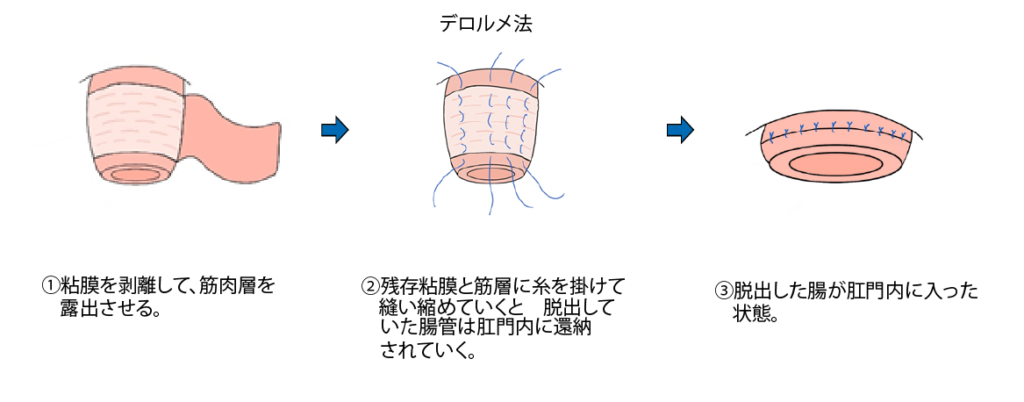 デロルメ法