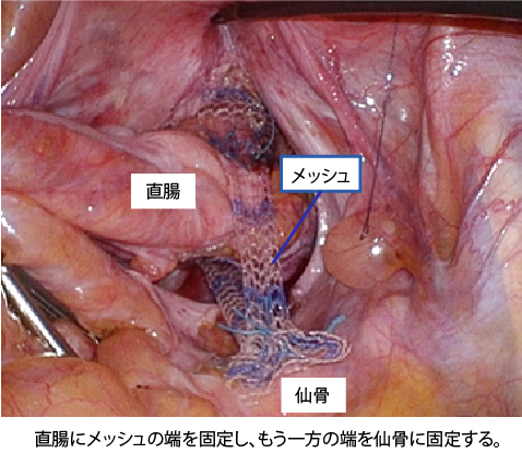 直腸固定術