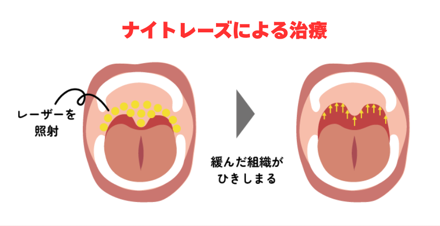 レーザー照射によるいびき治療での気道拡張イメージ